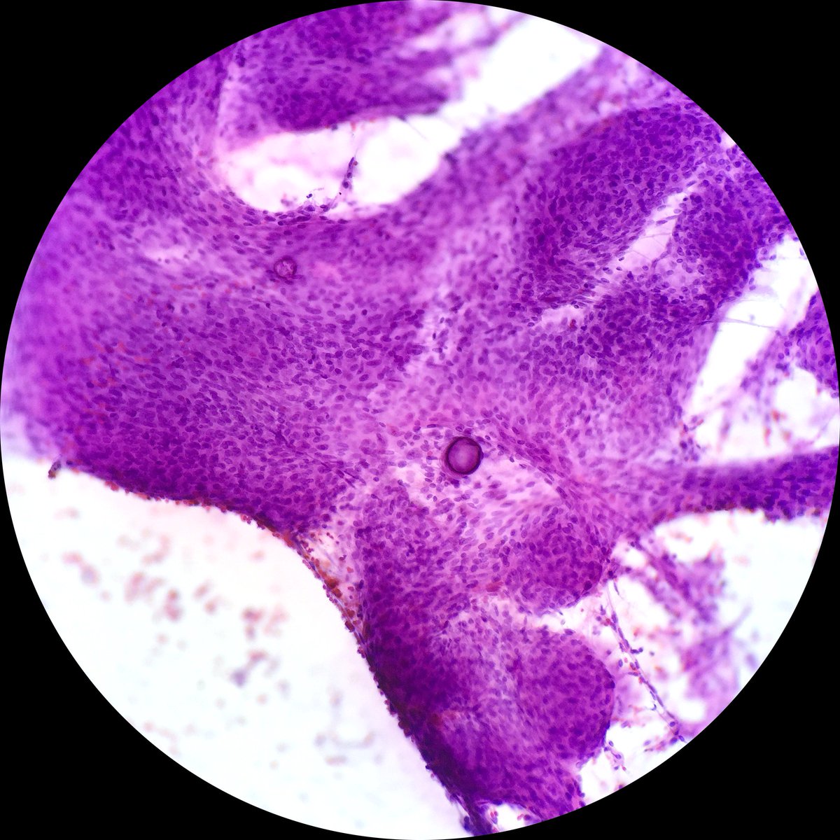 pathtutor_com's tweet image. ihcgame.com Meningioma smears and permanent sections @JMGardnerMD @JennyKHoang @pbaleixo @syntheslide