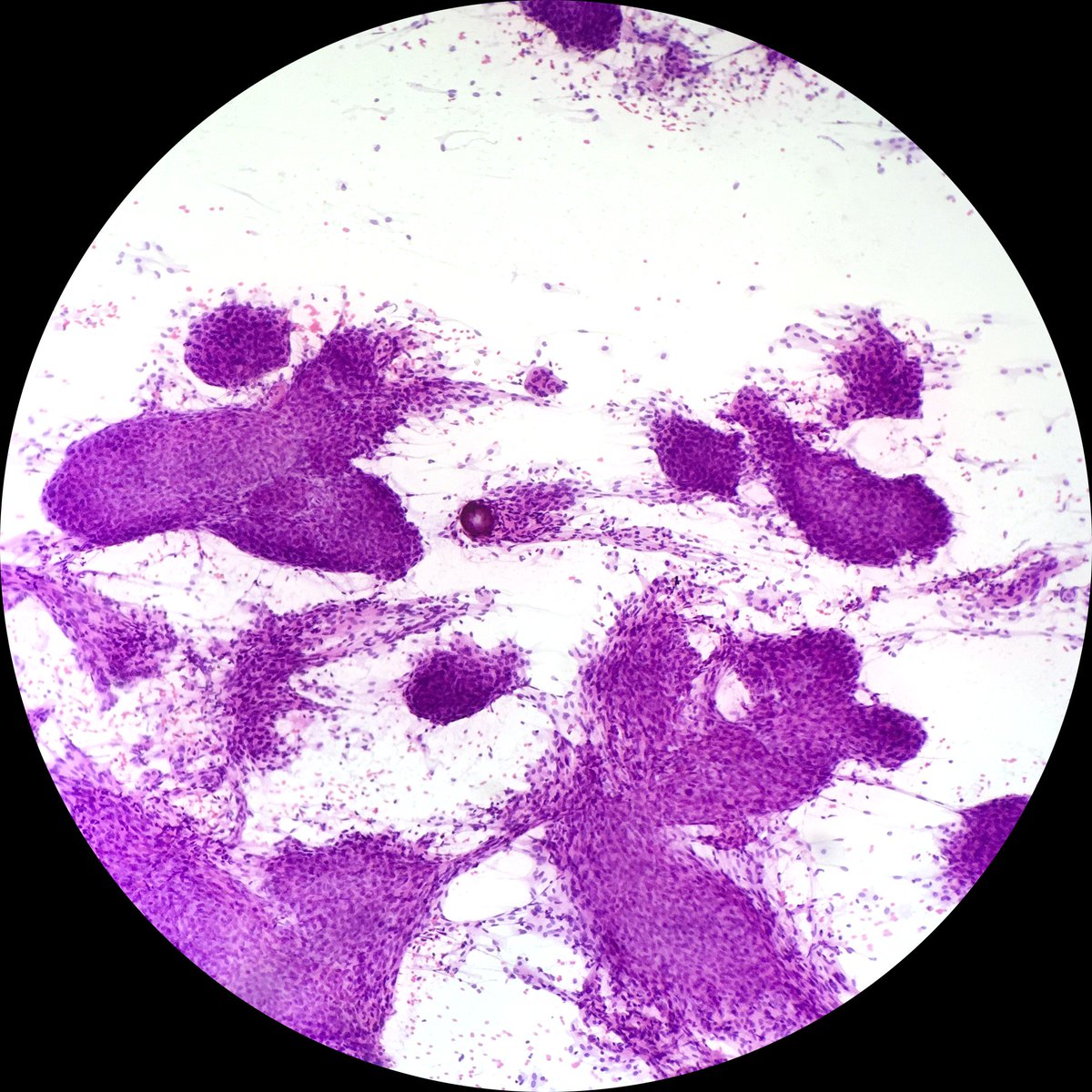 pathtutor_com's tweet image. ihcgame.com Meningioma smears and permanent sections @JMGardnerMD @JennyKHoang @pbaleixo @syntheslide