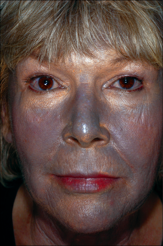 What is argyria, a condition that turns skin colour to blue?