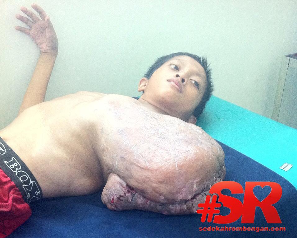 SRbergerak's tweet photo. 11. Mohon doa &amp; dukungan utk Ahmad, saat ini dia telah menjalani operasi &amp; bbrpa rangkaian operasi lg stlh ini. http://t.co/m8AeZIz5Cf