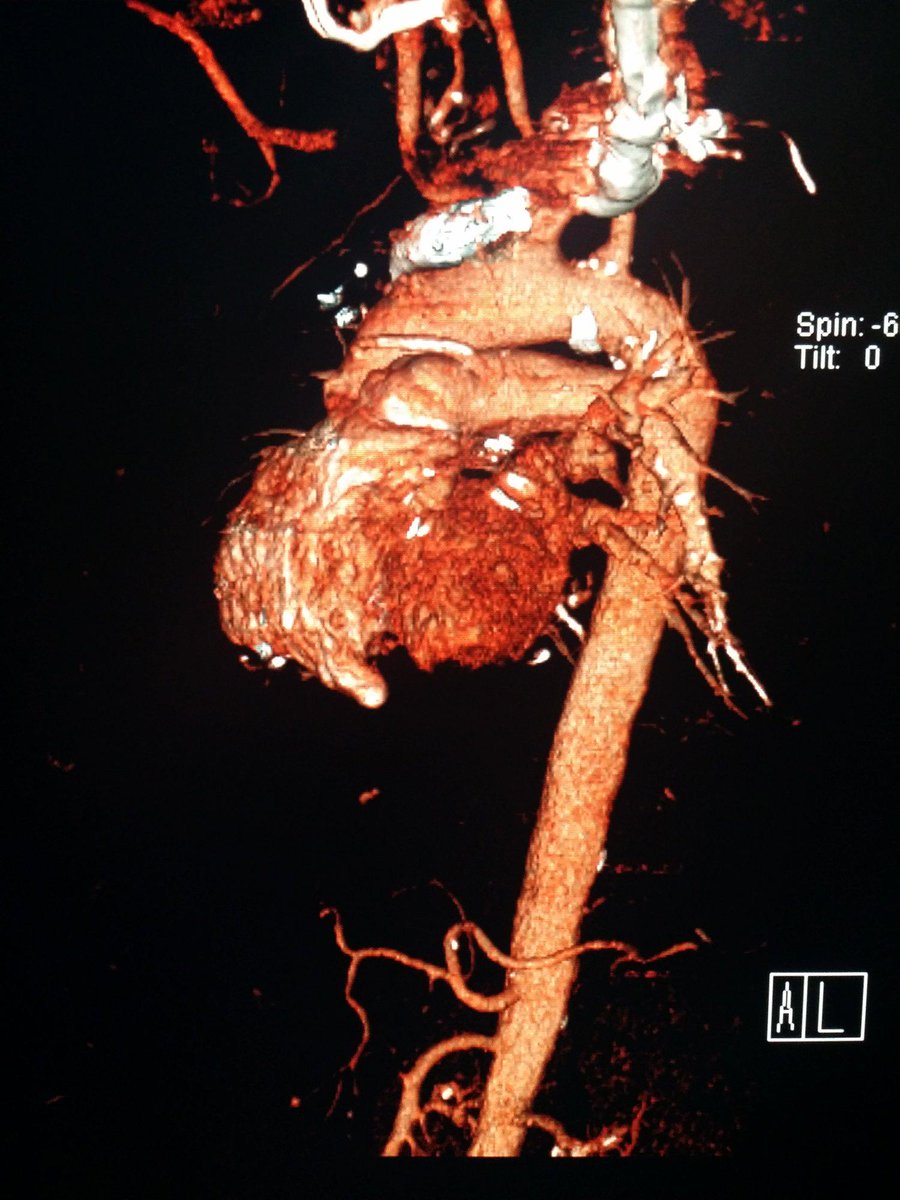 NBRadiologists's tweet photo. #Multidetector #CT of the #chest shows #heart and #aorta in #3D #reformats. #radiology #breastcancerawareness http://t.co/tWDO00uaQ0