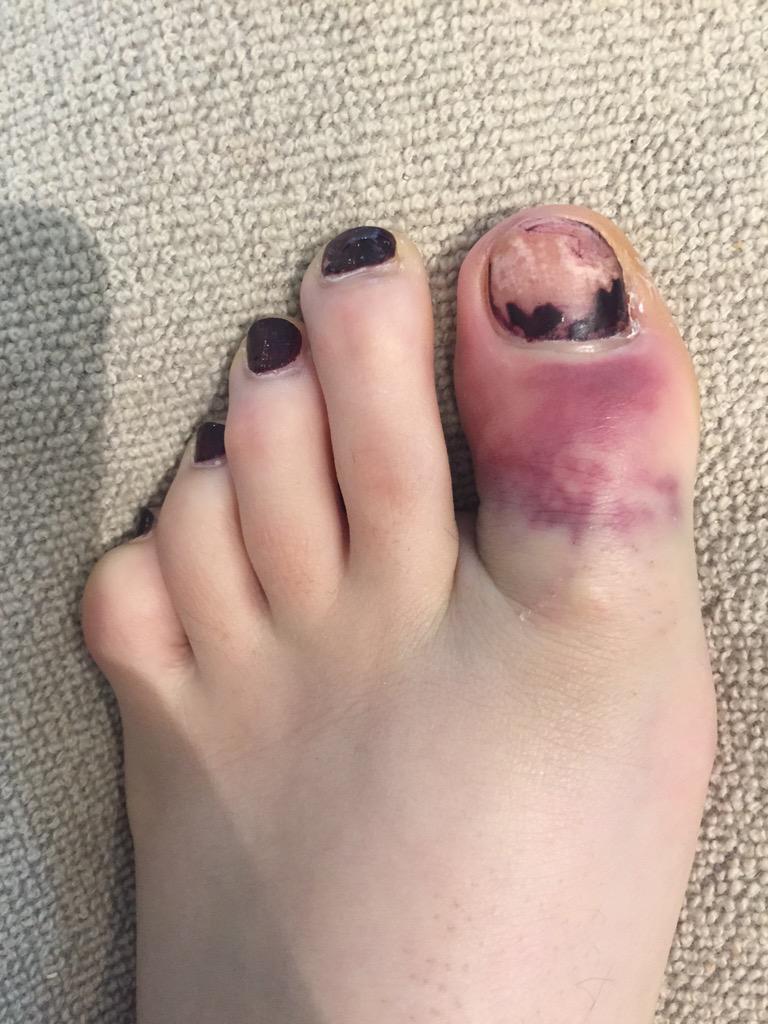 Sorana Cirstea on Twitter: "No clue how long this will take to heal.Waiting  to see how it develops 😔 http://t.co/CwnsF8C07Z" / Twitter