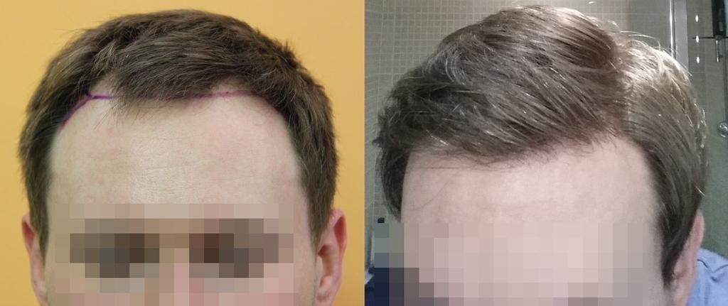 Hair Transplant Ass (@HTAssistance) / Twitter Hair Transplant Ass (@HTAssistance) / Twitter