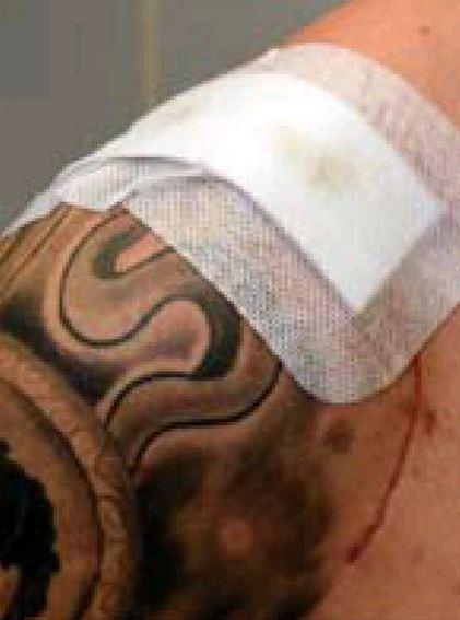 The scar on Jovan's shoulder is still visible; photo: Het Nieuwsblad The scar on Jovan's shoulder is still visible; photo: Het Nieuwsblad
