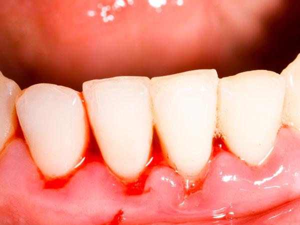 DENTISTwit's tweet photo. Gusi bengkak adalah salah satu tanda awal perubahan hormonal saat hamil. http://t.co/R9QUVJqEL7