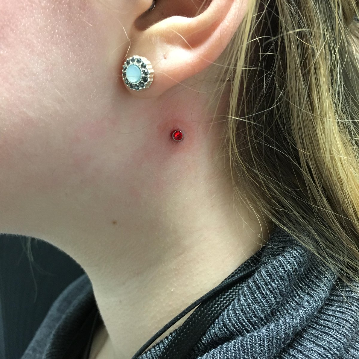 Vampire bite dermals