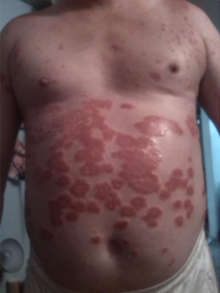 La psoriasis sobre oms