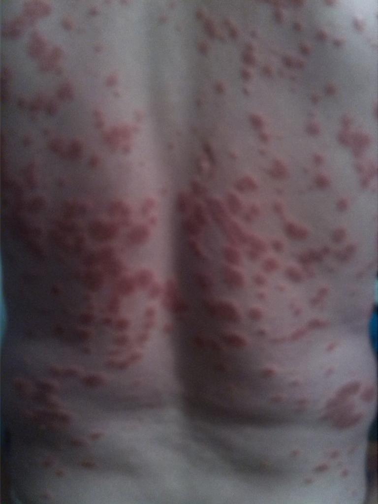 Que clima es mejor a la psoriasis