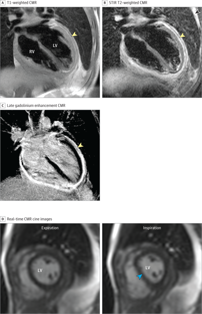 pericarditis jama