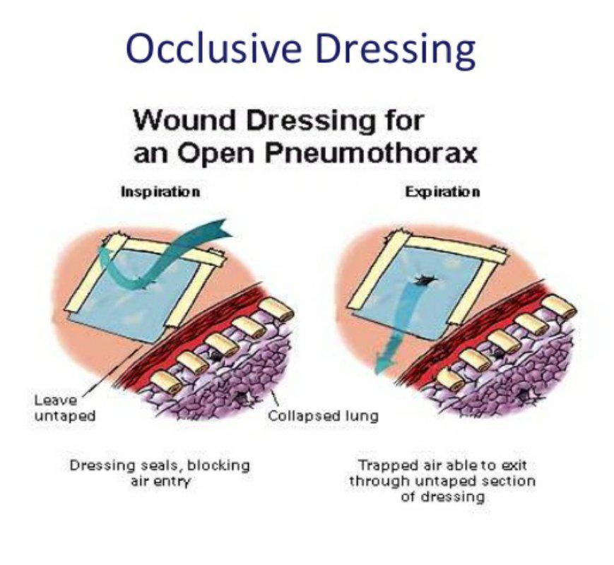 Open Pneumothorax Dressing