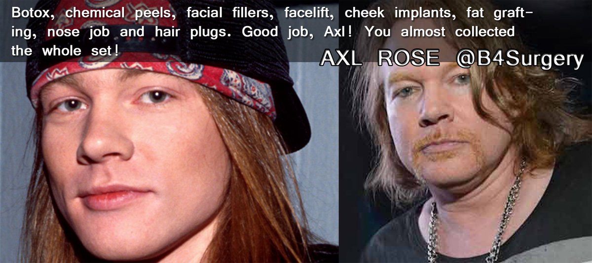 Axl Rose Before And After