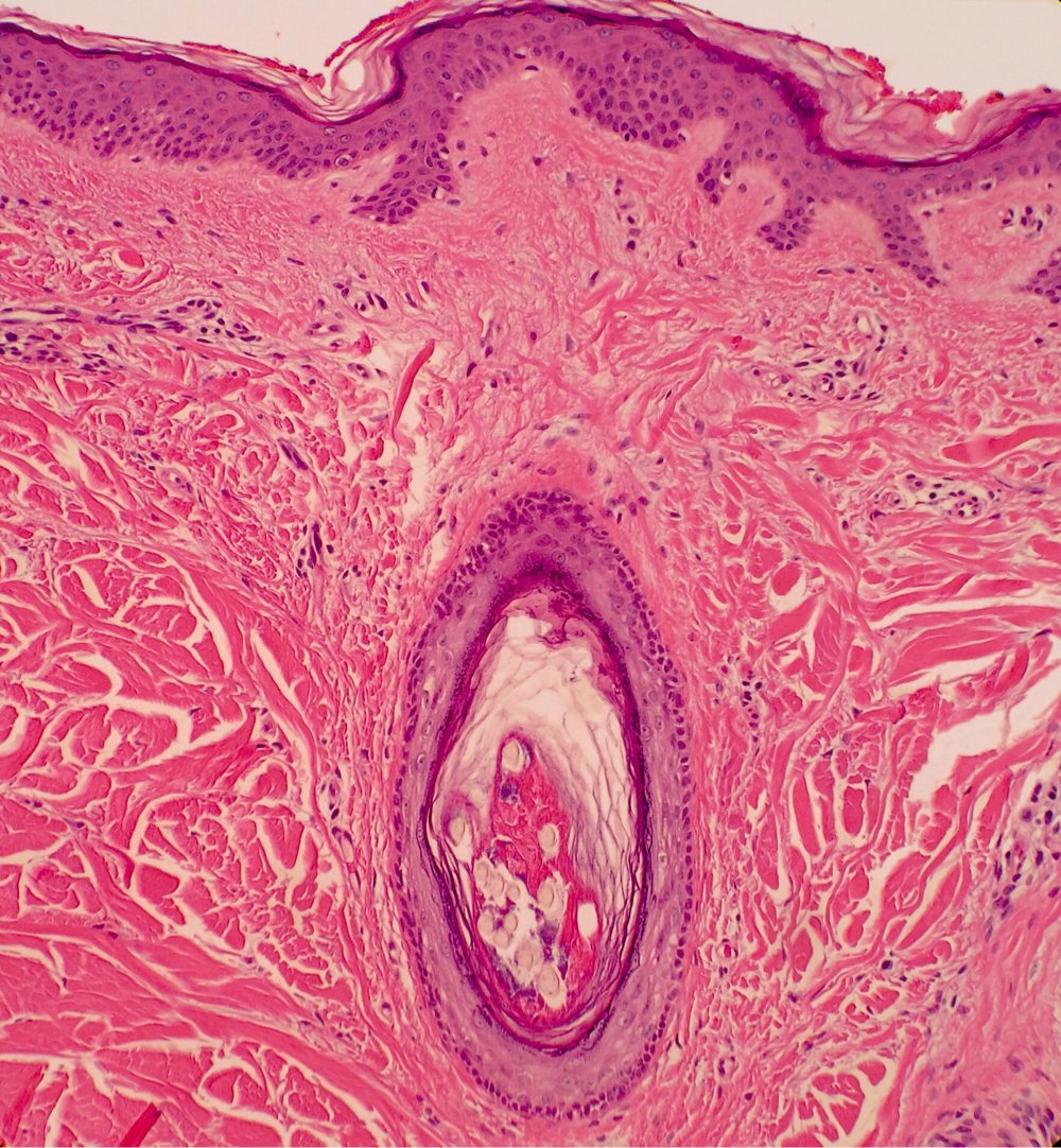 DermpathMGH's tweet photo. nice example of trichostasis spinulosa! https://t.co/7X6Riok1Q7