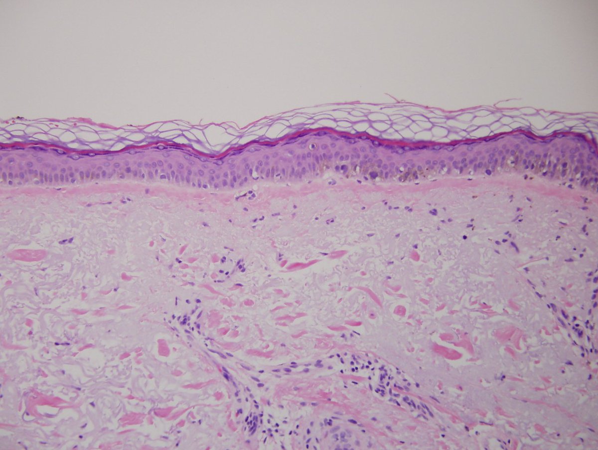 Dermpathl's tweet photo. Melanoma in situ, lentigo maligna type. R Cheek, 79-year-old woman. 4th photo: Subtle histologic border #dermopath https://t.co/ampxKTsFUg
