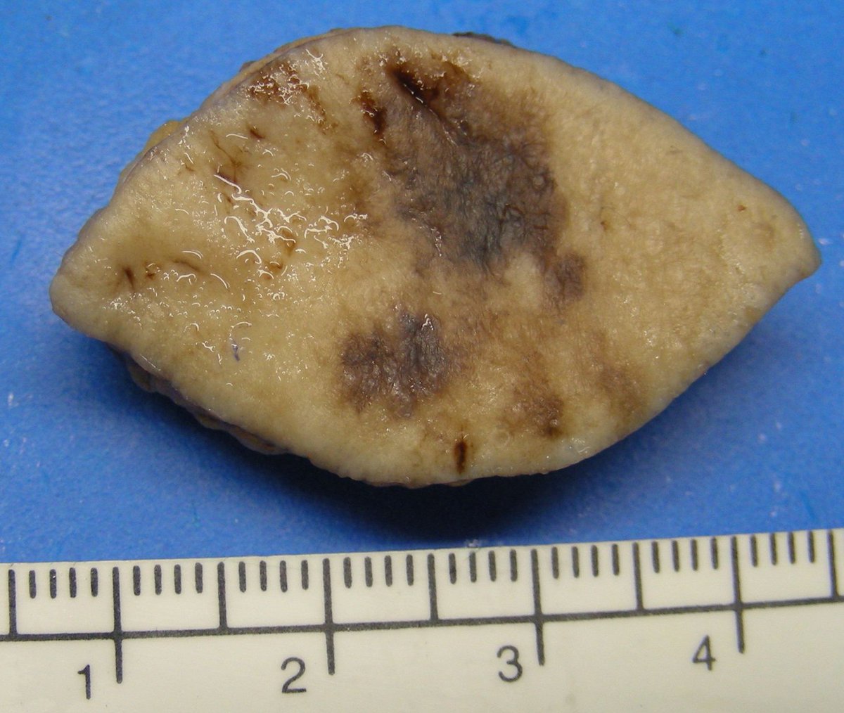 Dermpathl's tweet photo. Melanoma in situ, lentigo maligna type. R Cheek, 79-year-old woman. 4th photo: Subtle histologic border #dermopath https://t.co/ampxKTsFUg