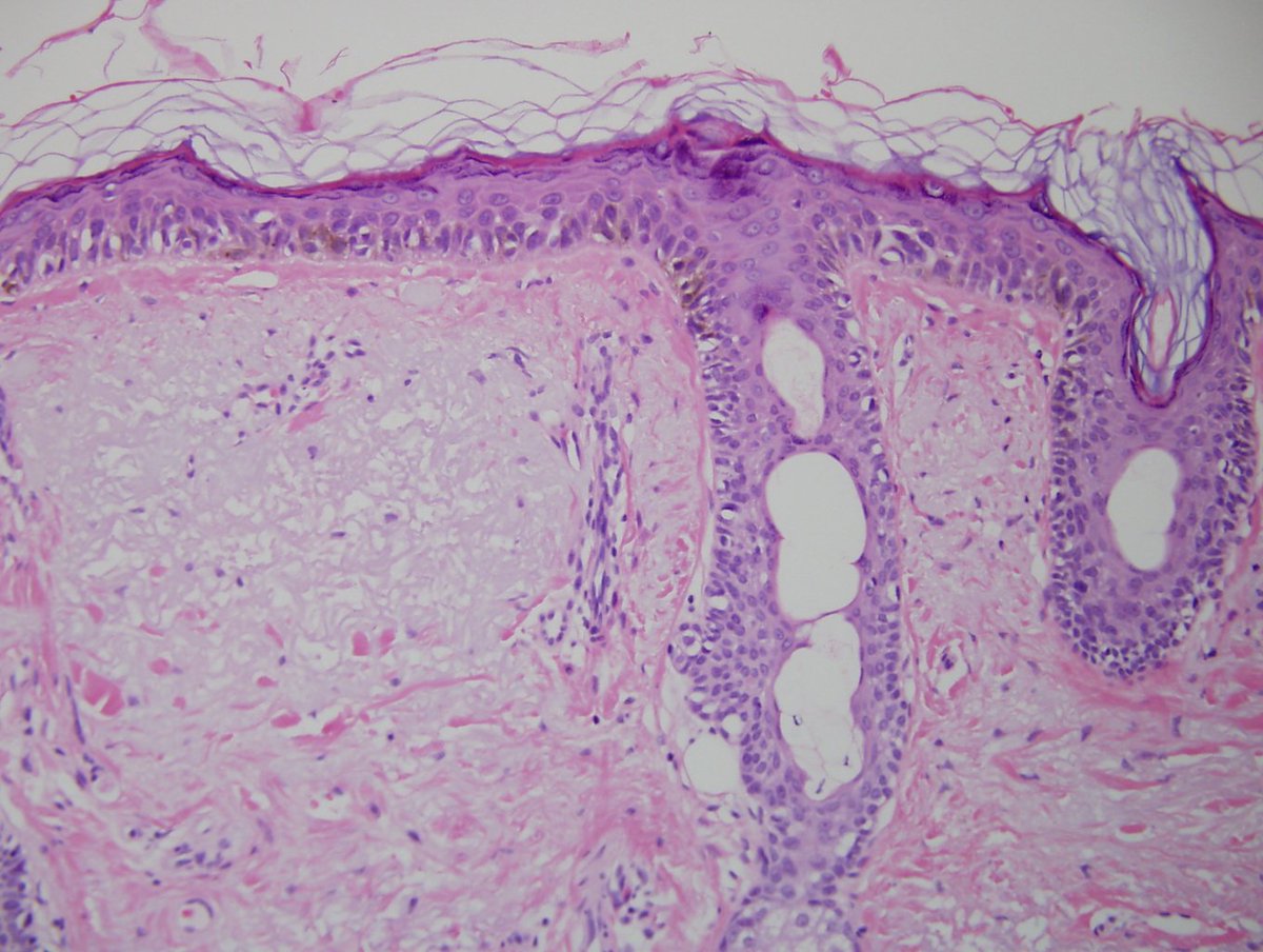 Dermpathl's tweet photo. Melanoma in situ, lentigo maligna type. R Cheek, 79-year-old woman. 4th photo: Subtle histologic border #dermopath https://t.co/ampxKTsFUg