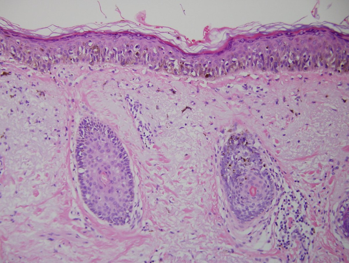 Dermpathl's tweet photo. Melanoma in situ, lentigo maligna type. R Cheek, 79-year-old woman. 4th photo: Subtle histologic border #dermopath https://t.co/ampxKTsFUg