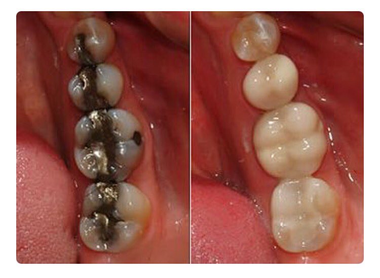 drlindajoy's tweet image. Which would you choose? 😳
SaremiJohnstoneDentistry.com
#smile #mercuryamalgam #qualitydentistry