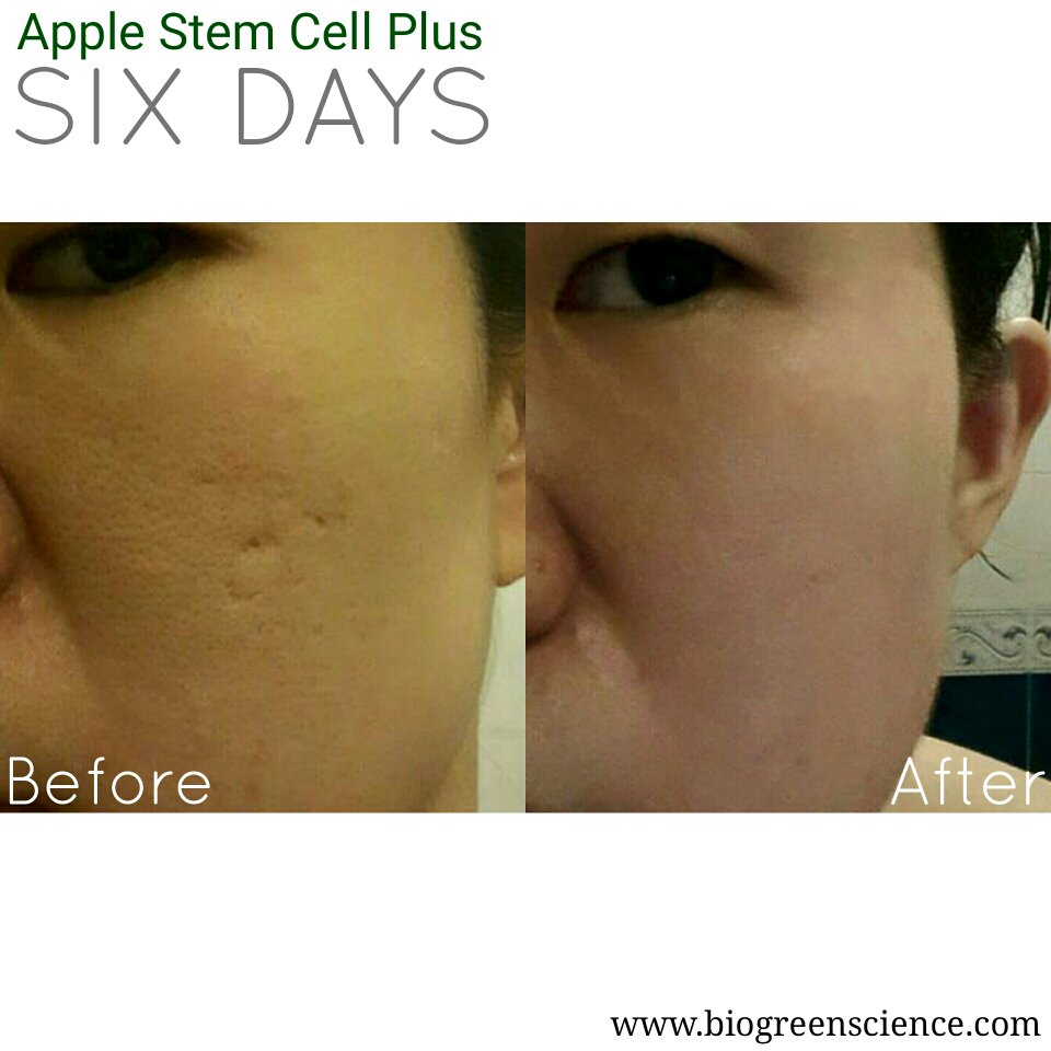 BiogreenScience's tweet photo. Six days with Apple Stem Cell Plus. #biogreenscience #testimony https://t.co/NR7etd6mdw