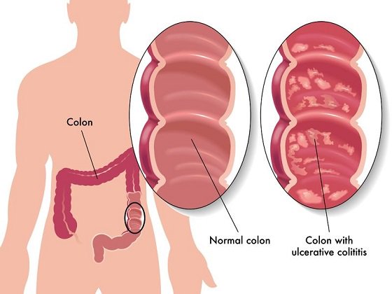 coolbeansweb23's tweet photo. RT iliganonko Surgical Options To Curb Ulcerative Colitis https://t.co/gSiaVObuNk https://t.co/MI9nnl9WQr #colit… https://t.co/wcf24AOZtV