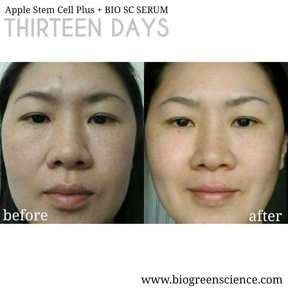 BiogreenScience's tweet photo. Penggunaan Apple Stem Cell Plus dan Bio SC Serum secara teratur dalam 13 hari. #biogreenscience #testimony https://t.co/5VOxAn9FIX