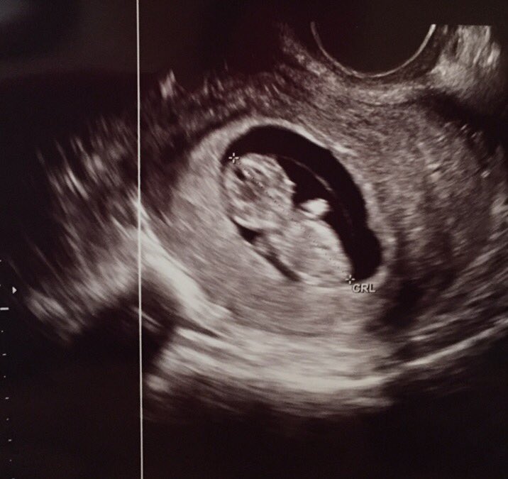 dianarozo's tweet photo. Ya tenemos deditos 🖐🏻😍❤️🍼👪👼🏼 #pedacitodevida #teamamos https://t.co/2sfsxKbUMh