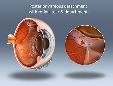MedicalArtist's tweet photo. PVD, retinal tear - detachment https://t.co/KI8vIelIc5 https://t.co/dEhGyTWQg9