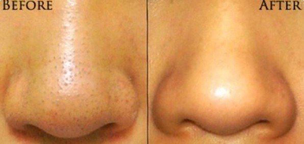 LiveTodayBlog's tweet photo. #Blackheads #info #tips Easy Masks to remove Black-Heads - " Live Today! " https://t.co/tFtNQwBCTP https://t.co/1ppMpXNtif