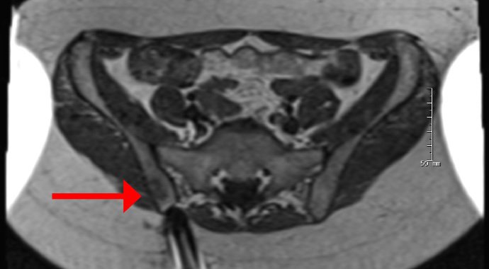 Case of woman w/ hip pain illustrates the value of using MRI for guiding some biopsies bit.ly/1zd8De1