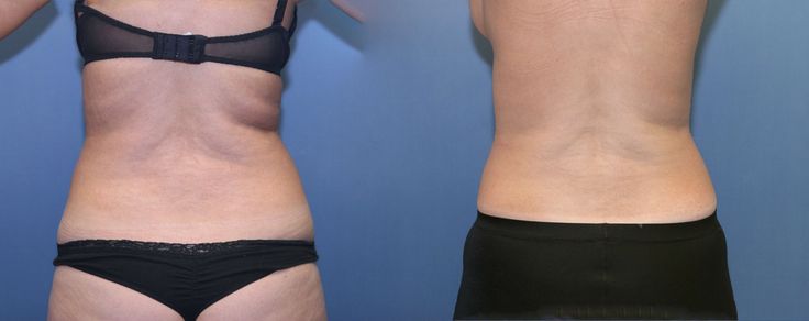 Ameri_Lipo's tweet photo. 1-2 inch circumference loss after painless #iLipo laser fat loss treatments. Available at https://t.co/N9Ff0lg3c3 https://t.co/RBvjnQVQ91