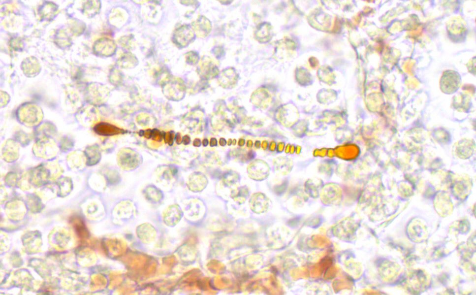 estheryoud's tweet photo. Lovely example of asbestos body in the lung. Needle in a haystack! #pathology #autopsy #histology #npw2015 https://t.co/hl97XNT1jo