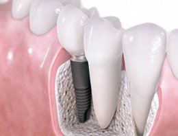 1 günde implant nasıl oluyor?
sagliklibirdis.com/1-gunde-implan…

#GüceHükmet #beklentim New York Times Umut Oran #Silvan