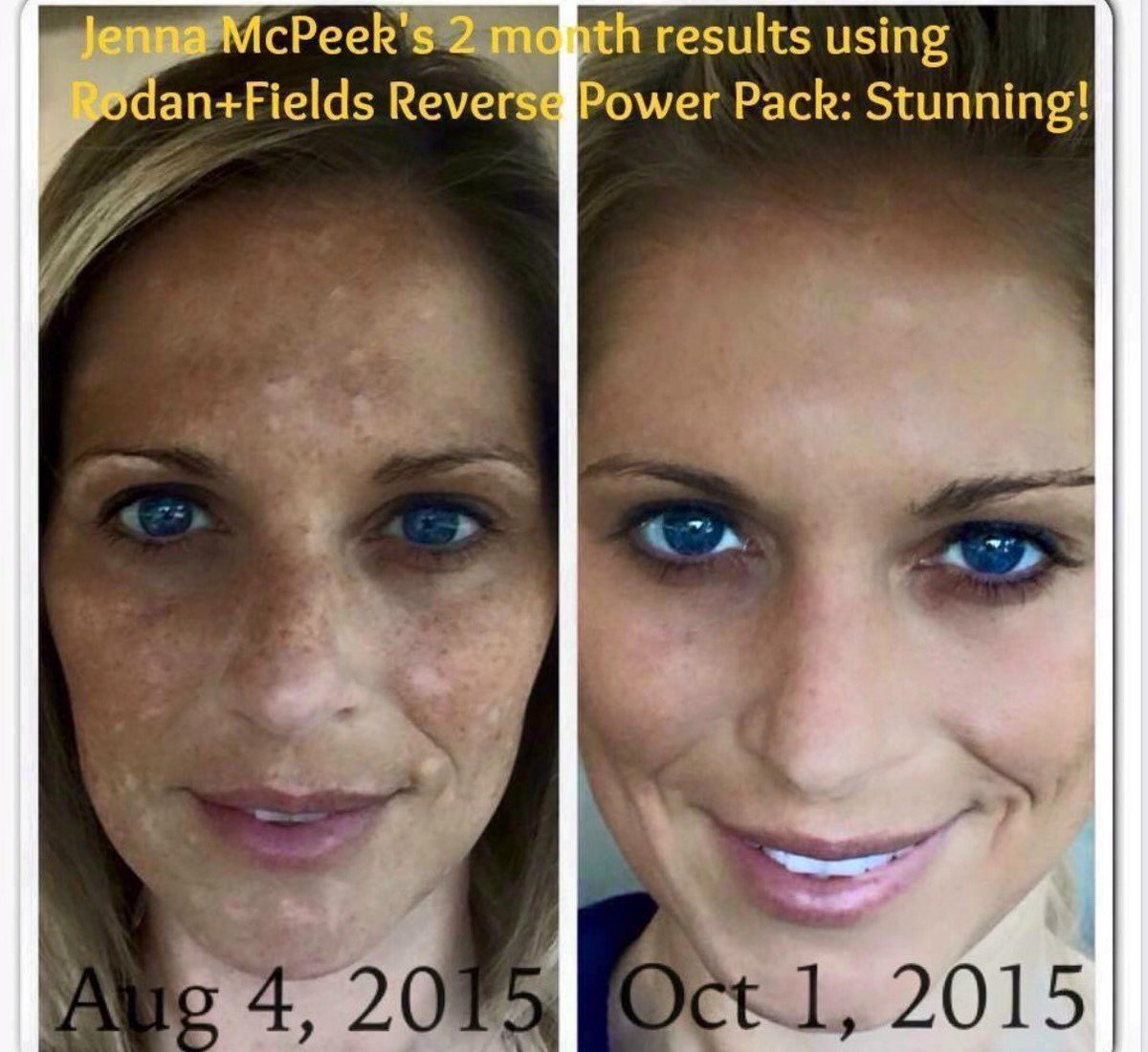 Stacy41310's tweet photo. Rodan + fields reverse is amazing. #sundamagebegone #nomorebrownspots https://t.co/L2LAQSkn0L
