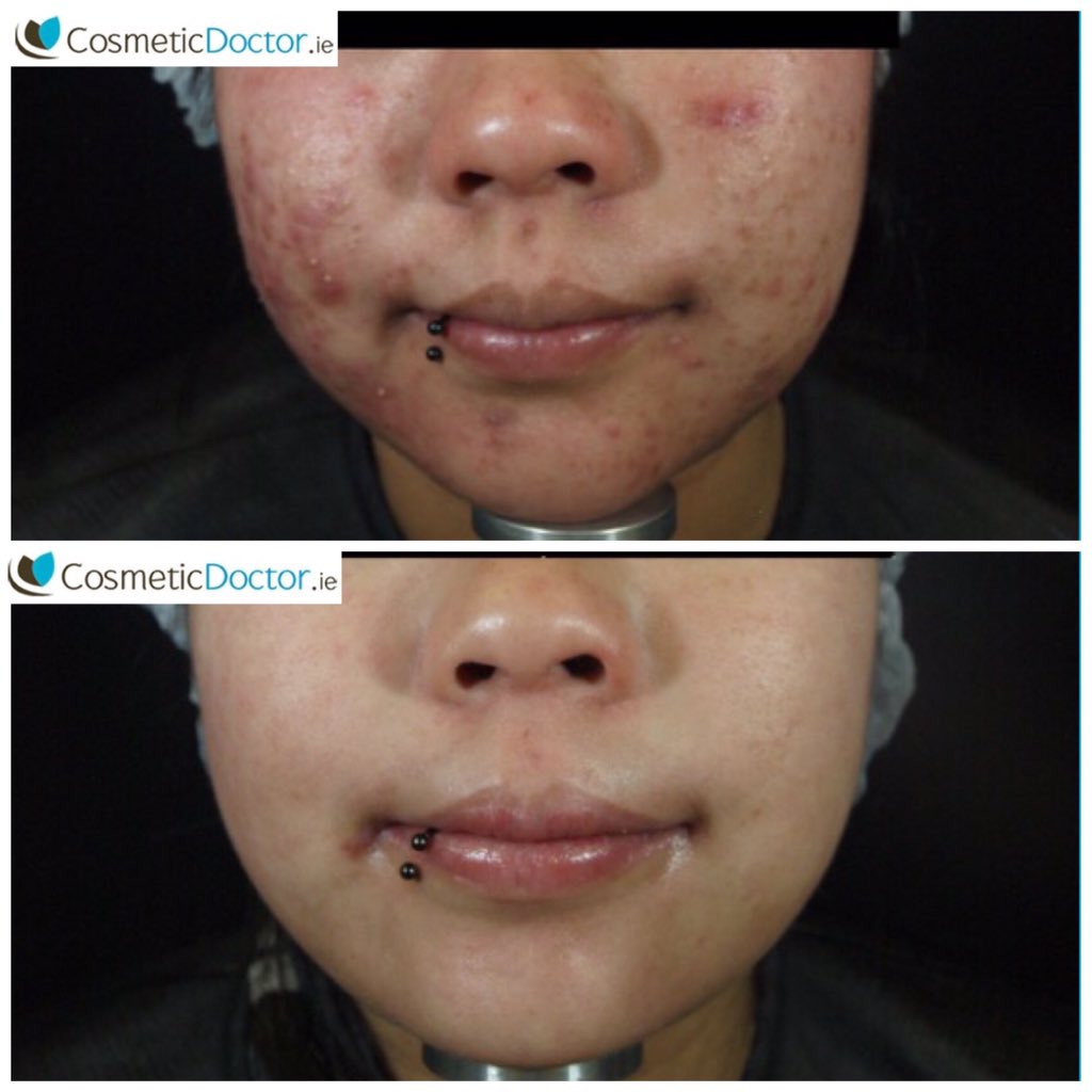 DRLISAFAY's tweet image. Fed up! #spots #acne @zoskinhealth. 5 months using ZO Medical and #roaccutane. We can help..