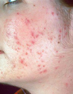 pimplesg's tweet photo. #AdultAcne #AdultPimple #AcneTreatment
Amazing Permanent Treatment of Pimples by Pimple.sg
https://t.co/Fd89oqgDFv https://t.co/wfzFvzuYJA