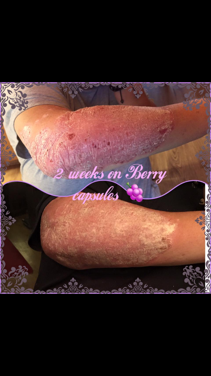 Does anyone suffer with psoriasis ? 

Fortunately I'm lucky enough not to but I can on... goo.gl/zpGyVl
