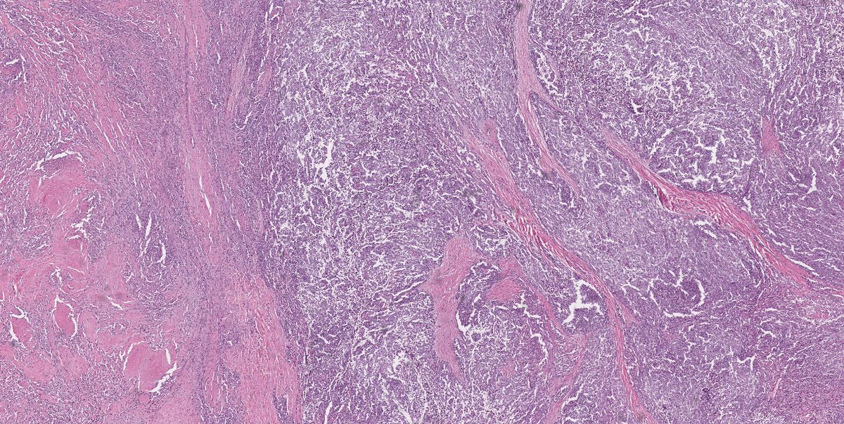 Spindle Epithelial Tumor with Thymus-Like Differentiation (SETTLE) #pathology #pathologists #histopath #histology