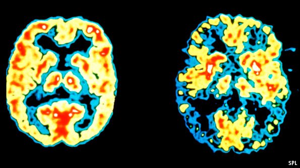 Svolta nella cura del morbo di Alzheimer