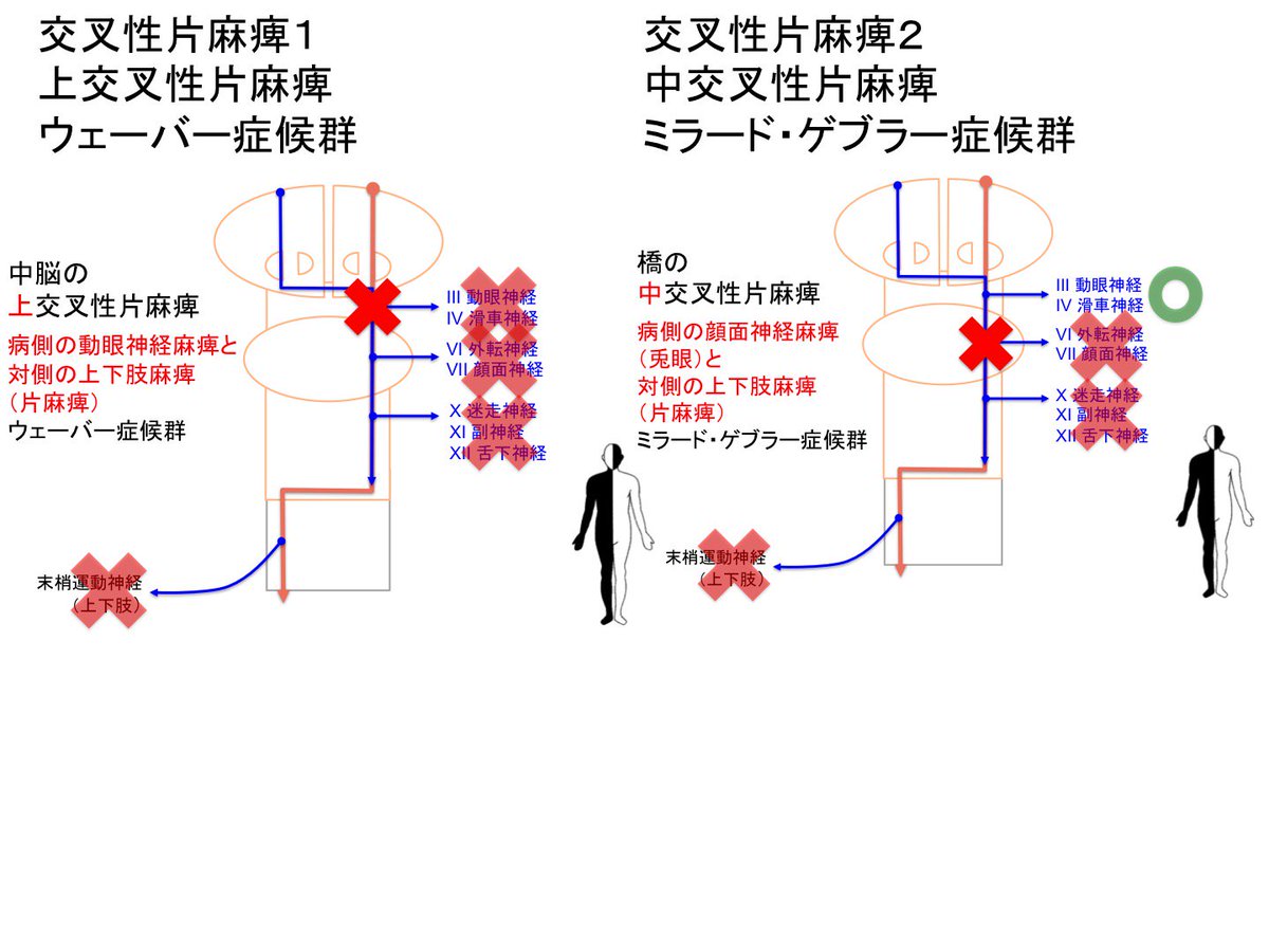 Oj A Twitteren 中枢運動神経麻痺2 1 交叉性片麻痺 上交叉性片麻痺 中交叉性片麻痺 上下肢の中枢運動神経と 脳神経 に含まれる中枢運動神経は左右を入れ替える場所が違う そのため 脳幹片側の病変では交叉性片麻痺という特徴的な麻痺を生じる T Co