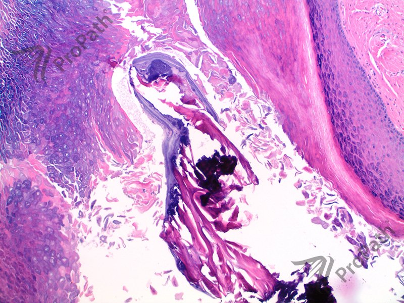 myiasis hashtag on Twitter