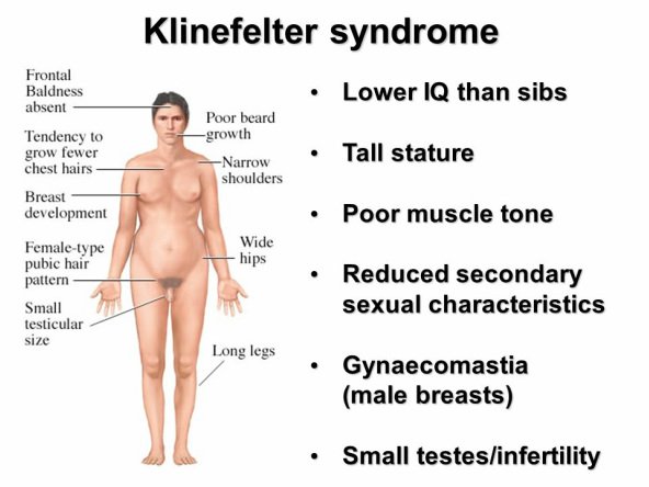 NCYCHPRINC's tweet photo. #KlinefelterSyndrome #infertilitychromosome #geneticdisorder #meninfertility https://t.co/3qxgOFQLdg https://t.co/gMGLP7bERj