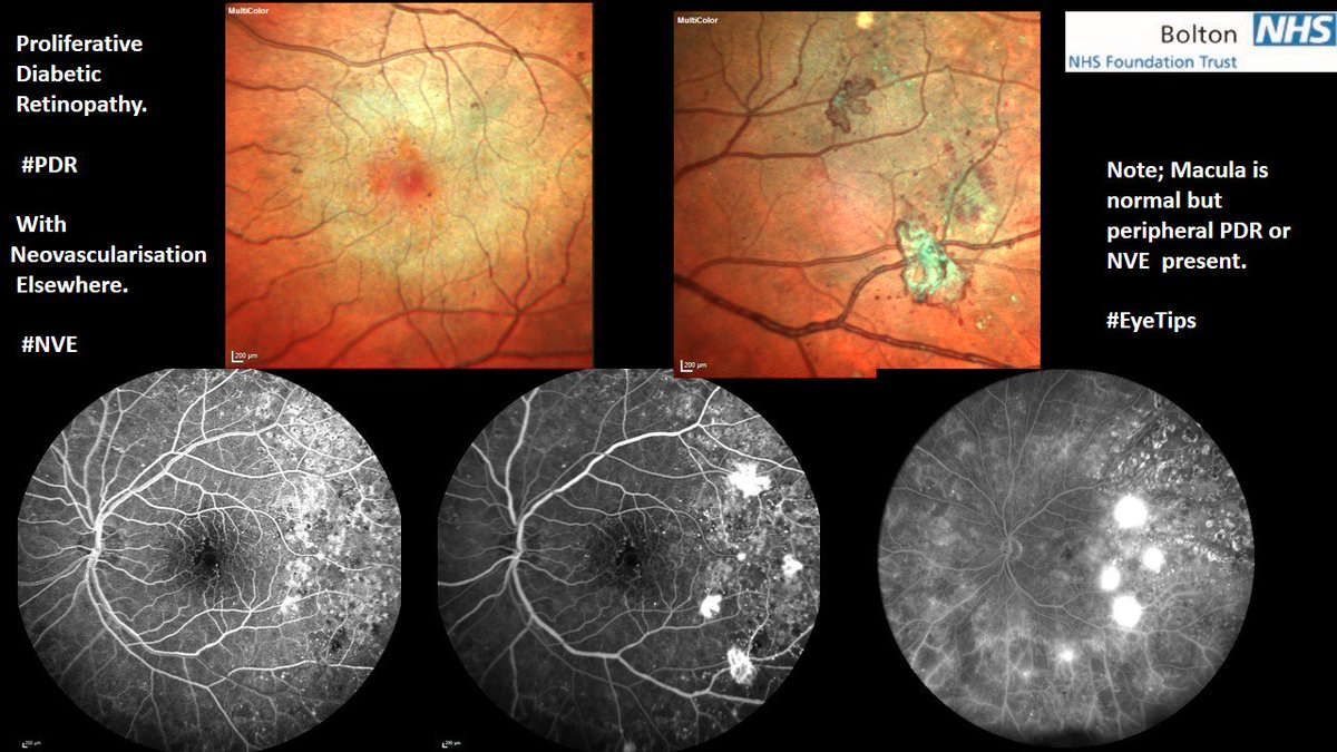 #Retinopathy of #diabetes may not cause eye symptoms until late. The #NVE in this #PDR case is asymptomatic #EyeTips