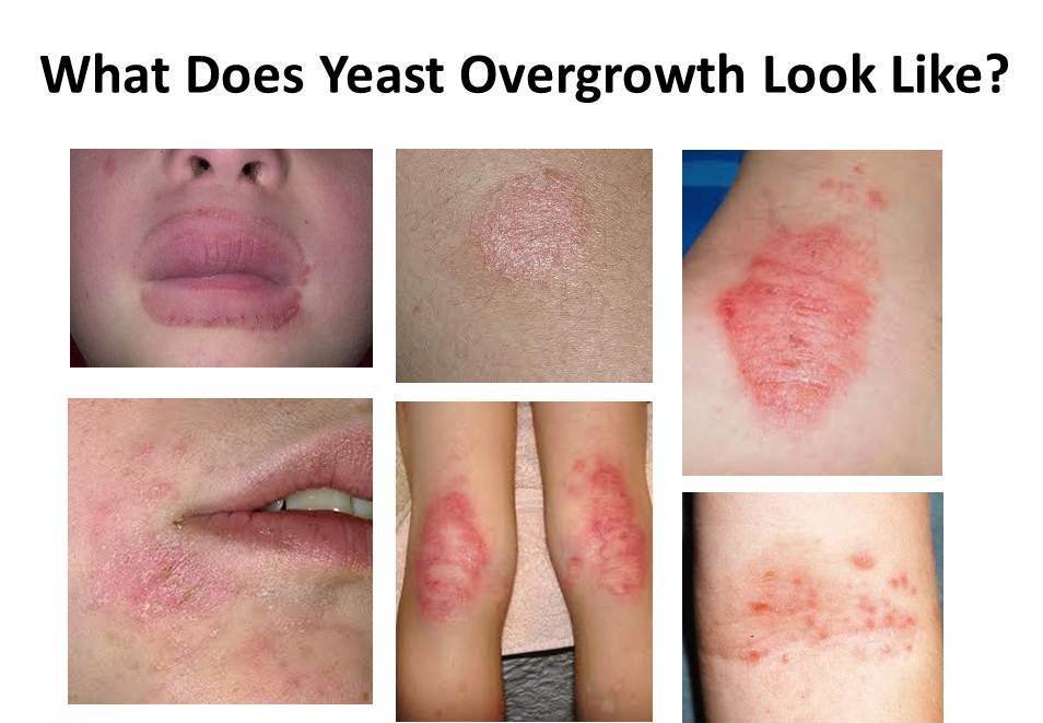 CandidaProtocol's tweet image. What Does #YeastOvergrowth Look Like?