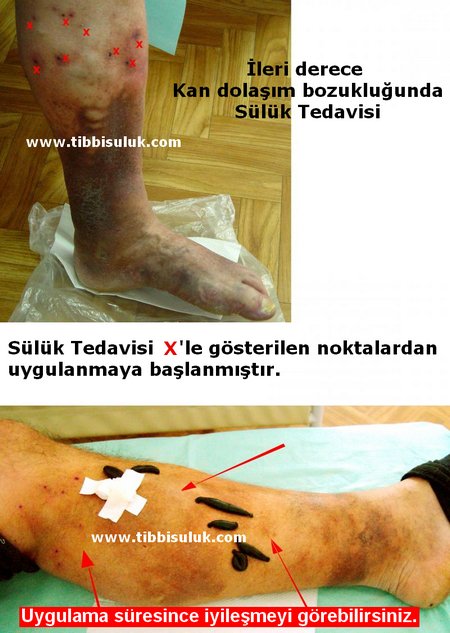 medicinalleech's tweet photo. #sülüktedavisi hakkında aradığınız her şey 
https://t.co/49zc4vRTjD https://t.co/kGw3qOYRQx