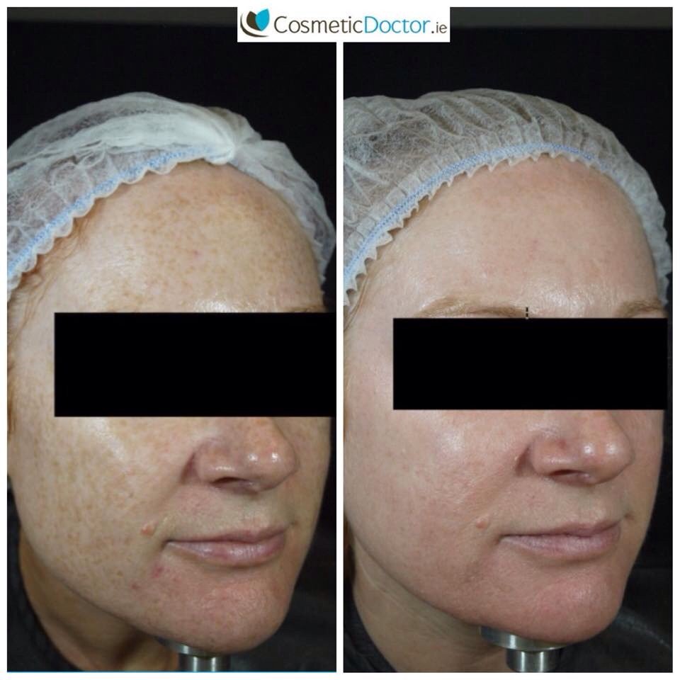 DRLISAFAY's tweet image. One of our clients 2 months post @zoskinhealth level 3 kit and two #dermapen #microneedling. #skincare #skinhealth.