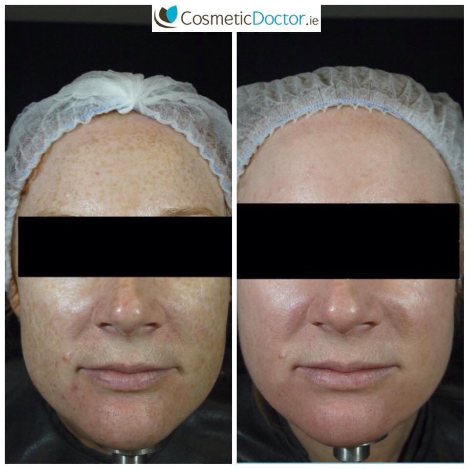 DRLISAFAY's tweet image. One of our clients 2 months post @zoskinhealth level 3 kit and two #dermapen #microneedling. #skincare #skinhealth.
