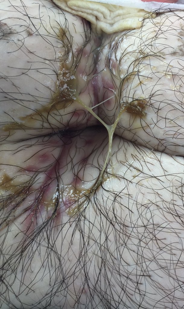 ChadShaft's tweet photo. My current situation. Not for the faint of heart. #Fat #LiquidFat #FatLeak #FuckMyLife #Disgusting #OddSmell https://t.co/Om5Vdq232H