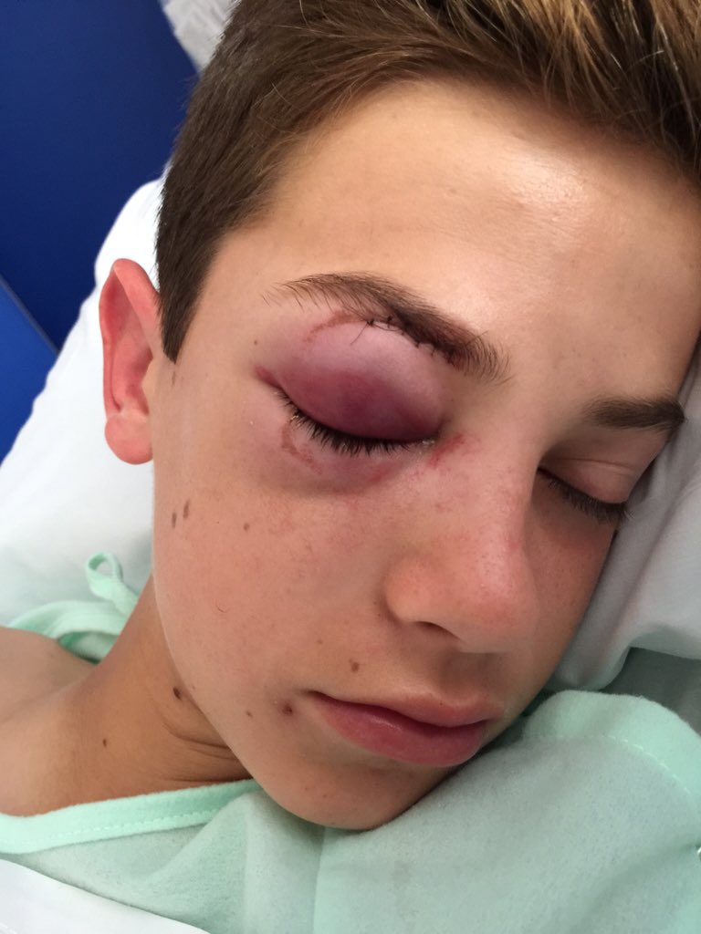 mamielke's tweet photo. My son was hit by a ball in a game. 3 fractures, a concussion &amp; bleeding behind eye. Bit better. Thank You God! https://t.co/57qeWwaT6M