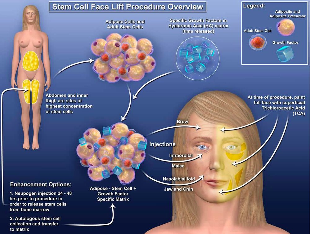 DrGiampapa's tweet photo. Here is an overview of the #stemcellfacelift. Go to https://t.co/LYVLvBMXIe to set up your consultation. #antiaging https://t.co/ZGbU46Xi1X