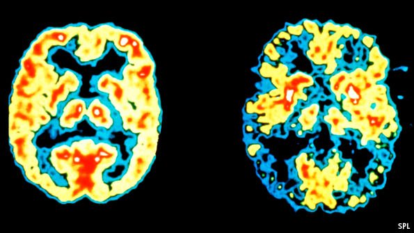 TheEconomist's tweet photo. Researchers see hints that there may be a surprisingly simple cause of Alzheimer's: a fungus https://t.co/V6qFm32eoE https://t.co/Hlc3a9mV7G