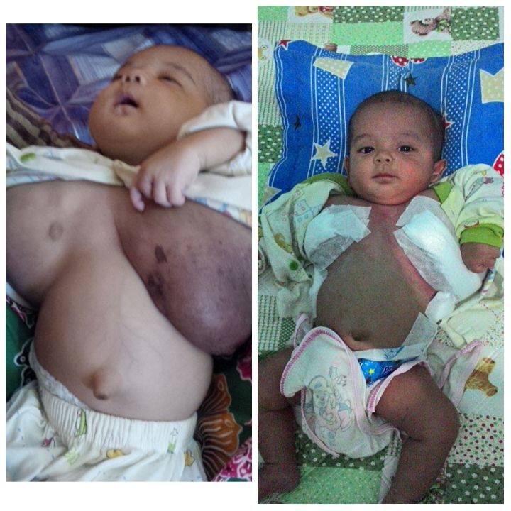 SRbergerak's tweet photo. Andhiro Ardiansyah (4bln, Lymphangioma) diperbolehkan plg dr RSSA pasca operasi. #SRmalang https://t.co/V4E451M9G5 via @heStyyii